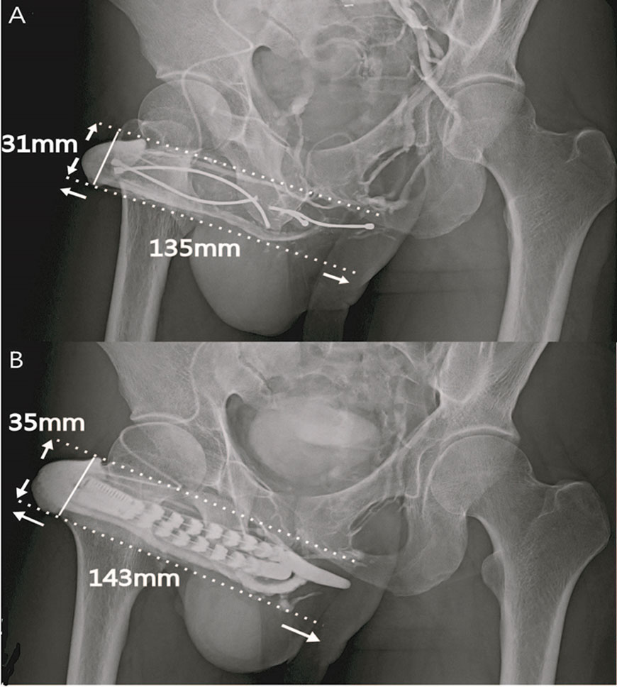 Both pre and post surgically placed penis enlargement x-rays. 